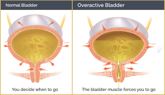 Overactive Bladder FAQ Urologic