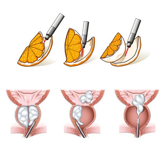 Medical illustration comparing HoLEP prostate tissue removal to peeling an orange